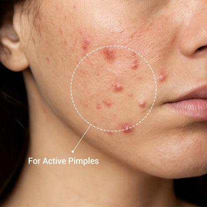Acne Drying Lotion Plus (1.8% Encapsulated Salicylic Acid) — 10 mL